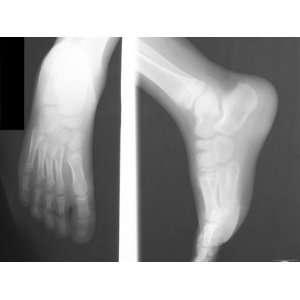  X Ray Normal Ankle and Foot Dorsal Lateral Foot Ankle 