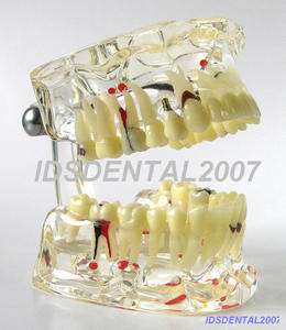 Dental Demonstration Pathologies Teeth Model(New)  